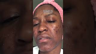 FUNGAL ACNE BREAKOUT OR PUSTULE INFECTION  PART 1  TAHJAERA [upl. by Henarat]