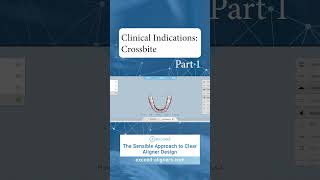 Clinical Indications Crossbite Part 1 [upl. by Aicilanna]