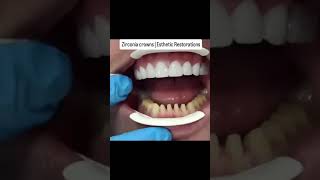 Zirconia crown🦷✨dentistshortvideoviralshorts [upl. by Yves]