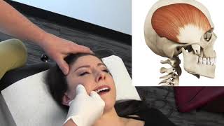 Temporal Headaches  Temporalis Muscle Internal Release Procedure  MSR Demo [upl. by Eisus]