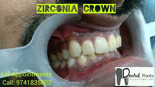 zirconia crown metal free crowns  smile designing [upl. by Vevina]