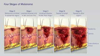 Treatment of Melanoma Skin Cancer by Stage [upl. by Pavia]