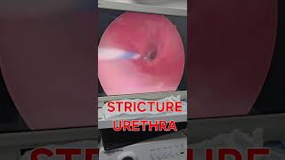 How stricture urethra look urethralstricturetreatment urethralstricture strictureurethra [upl. by Kuehn]