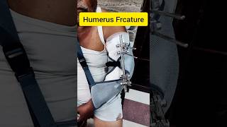 Humerus Displaced Frcature 3D [upl. by Delfeena]