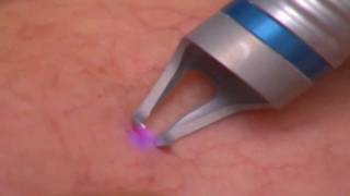 Laser Spider Vein Treatment at JVAI [upl. by Schwenk]