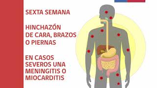 Video 2 Triquinosis síntomas y tratamiento [upl. by Saraann]