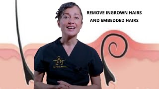 HOW TO REMOVE INGROWN HAIRS or EMBEDDED HAIRS [upl. by Ynafetse]