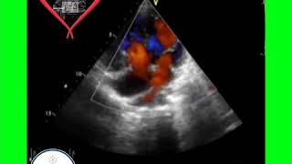 Ultrasound Board Review on Pediatric Echocardiography Double Outlet Right Ventricle TGA [upl. by Anayet521]