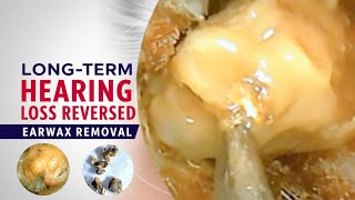 LongTerm Hearing Loss Reversed by Earwax Removal [upl. by Alodi]