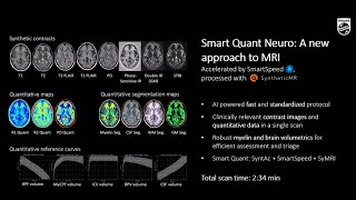 New Standards in Neuro Imaging with Fast AIbased Quantification [upl. by Ellerred509]