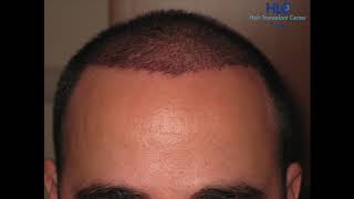 Hairforlife Kooperationsklinik HLC FUE Haartransplantation Türkei 2500 Grafts [upl. by Ymled]