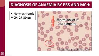 Hematology  1  U5L6  Morphological classification of anaemia by MCV  2 [upl. by Dunton929]