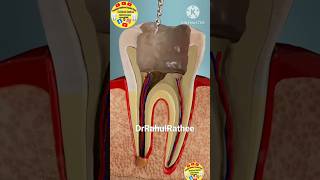 root canal treatment how to do root canal treatment dental root canal treatment shorts shortsfeed [upl. by Zanahs856]