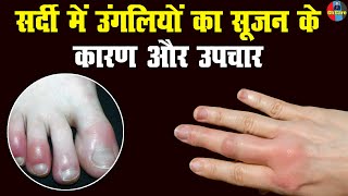 Swollen Fingers in Winter  सर्दी में उंगलियों का सूजन कारण और उपचार swollenfinger healthtips [upl. by Zitah5]