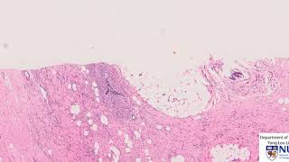 Breast Lobular carcinoma histology [upl. by Halonna]