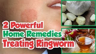 2 Powerful Home Remedies For Treating Ringworm [upl. by Notyep592]