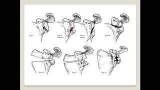 IDEBERG CLASSIFICATION OF GLENOID FRACTURE [upl. by Annahsohs110]