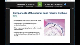 Low Grade Lymphoma In Trephine Biopsy And Its Diagnostic Pitfall [upl. by Meraree]