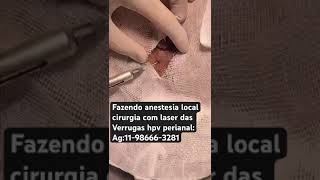 Fazendo anestesia local cirurgia Laser verrugas anais [upl. by February298]