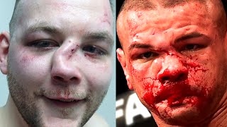 WARNING GRAPHIC Worst BROKEN Noses in UFC amp MMA [upl. by Lymn]