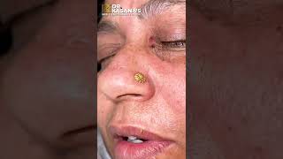 Warts Removal Treatment at dr Kasana Clinic [upl. by Leesa799]