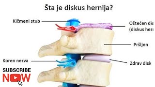 DISKUSHERNIJAlecenje bez operacijezivot bez bola DISCUS HERNIATION  treatment without surgery [upl. by Acenahs212]