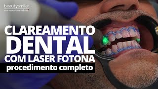 Clareamento dental com laser na prática [upl. by Marka]