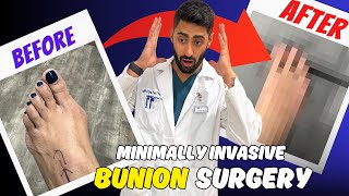 Patients Experience With Minimally Invasive Bunion Surgery [upl. by Balf]