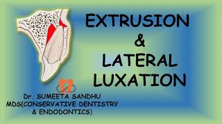 Extrusion and lateral luxation of teeth  Management Luxation injuries [upl. by Roselani372]