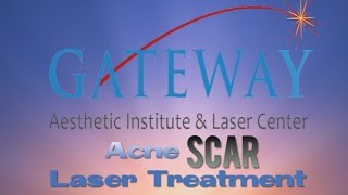 Acne Scar Laser Treatment  Gateway Aesthetics [upl. by Finegan]