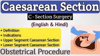 Cesarean section in hindi  Lower segment caesarean section in hindi [upl. by Idnac]