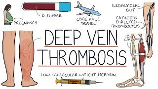 Understanding Deep Vein Thrombosis DVT [upl. by Alhan]