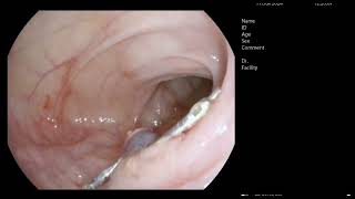 large pedunculated polyp Paris Ip removed with hot snare hemoclips in patient presented e anemia [upl. by Ardekahs148]