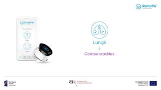 Lungs auscultation  coarse crackles 1 [upl. by Vasileior]