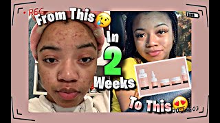 How I cleared my skin in TWO WEEKS 😱 w UNDERNEATH SKINCARE❗️ [upl. by Martell]