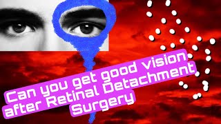 14 Can you get good VISION after Retinal Detachment Surgery RETINAL DETACHMENTretinaldetachment [upl. by Pat]