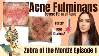 Acne Fulminans  A Severe Acne Variant  Zebra of the Month [upl. by Arayc]