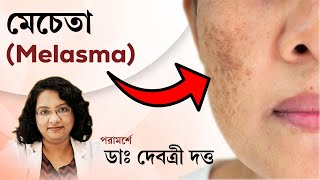 মেচেতা কিভাবে সারানো সম্ভব । Dermatologist Explains Why Melasma is So STUBBORN [upl. by Oramlub]