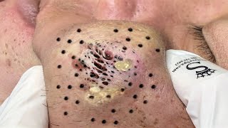 Blackhead Removal With Sac Dep Spa 1000339 [upl. by Ecnaiva]