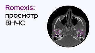 Возможности программы Romexis Viewer просмотр ВНЧС [upl. by Lihas]