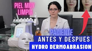 Como Hacer Hydro Dermoabrasion y Resultados Antes y Después [upl. by Yrolam]