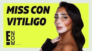 MISS UNIVERSO TIENE A LA PRIMERA CANDIDATA CON VITILIGO EN SU HISTORIA [upl. by Sivla]