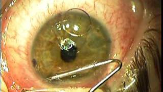 IntraLase Lasik Surgery  Right Eye [upl. by Amandi]