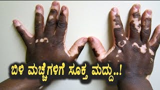 Best Treatment for White spots on the skin  Kannada Health Videos  Top Kannada TV [upl. by Iila452]