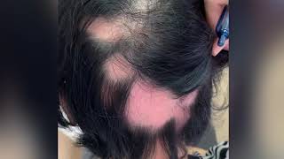 โรคผมร่วงเป็นหย่อม Alopecia Areata AA เกิดจากอะไร รักษาได้อย่างไร หมอรุจชวนคุย รักษาผมร่วงผมบาง [upl. by Chris]