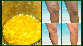 HOW TO GET RID OF VARICOSE VEINS FAST  NATURAL REMEDY FOR VARICOSE VEINS Khichi Beauty [upl. by Stu]