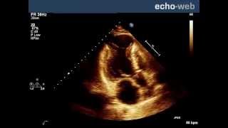 EchoWeb Left Ventricular Aneurysm [upl. by Theall]