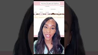 HOW TO REDUCE ACNE SCARS [upl. by Llywellyn]