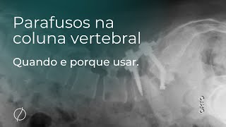 Parafusos na coluna Quando e em quais casos é necessário implantálos cirurgiaodecoluna [upl. by Childs603]