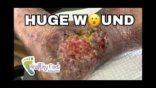 Huge Wound on Foot and Leg [upl. by Stan]